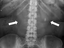 Image Result For X Ray Horseshoe Kidney X Ray Kidney Horseshoe