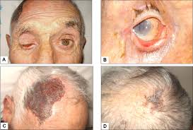 Educational image placeholder: visual symptoms and urgent warning signs in giant cell arteritis