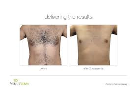 Skinspirit palo alto laser hair removal technology is proven to give you smoother, softer skin, forever. Ipl Hair Removal Rancho Cucamonga Perfect Image Med Spa