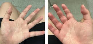 Image result for Angioedema