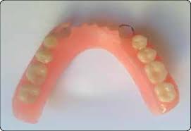 A removable partial denture (rpd) is a denture for a partially edentulous patient who desires to have replacement teeth for functional or aesthetic reasons and who cannot have a bridge (a fixed partial denture) any reason, such as a lack of required teeth to serve as support for a bridge (i.e. Finished Acrylic Removable Partial Denture With Wrought Wire Clasp At Download Scientific Diagram
