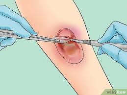 Modern take on a medicine cabinet: 4 Ways To Treat Bedsores Wikihow