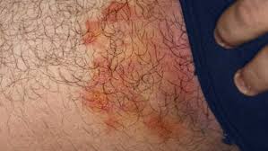 Image result for sore skin in the groin area
