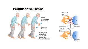 Advanced stages may increase the risk of health complications that reduce. Parkinson S Disease Stages Prevention Treatment Parents Avenue