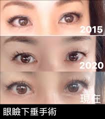 眼瞼 下垂 手術 ブログ