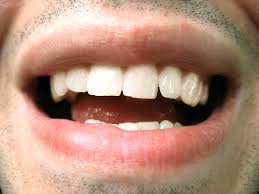 The phrase tongue thrusting apparently was coined around 1958, and is also referred to as anterior tongue position, anterior resting tongue position, reverse swallow, infantile swallow, and reverse infantile swallow. Lisp Vs Tongue Thrust What S The Difference Greenspoint Dental Houston Dentist