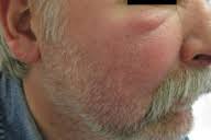 Toute l'actualité sur france bleu. Morbihan Disease