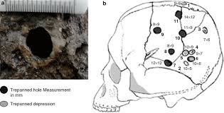 All breeds, all types of dogs, all seeking new homes. A Enlarged View Of The Trepanned Hole In Harappan Skull H796 B B Download Scientific Diagram