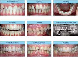 Maybe you would like to learn more about one of these? Nak Pakai Braces Ramai Klinik Pergigian Dr Smile Facebook