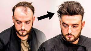 There are no miracle hair loss cures or baldness cures in a bottle, but often very effective, supportive treatments which include medical grade topical hair growth solutions. Mens Hair Loss Treatment Hairstyle Transformation Does It Work Youtube