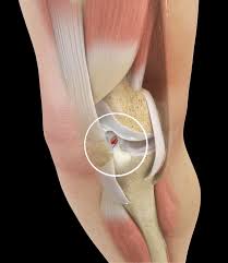The anterior cruciate ligament (acl) helps keep the knee stable, and prevents it from sliding forward. Return To Basketball After An Acl Tear