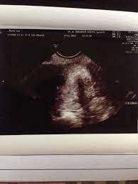 Penebalan dinding rahim merupakan salah satu faktor penghambat kehamilan untuk wanita. My Long Journey To Get Pregnant Steemkr