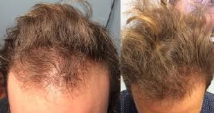 Welcome to mind blowing hair replacement. Stem Cell For Hair Loss Dr Ben Behnam Md Faad Best Dermatologist Los Angeles