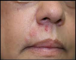 The human species is the only reservoir of the virus and usually, the virus enters damaged epithelium or mucosal surfaces, secondary to abrasions or trauma 2. Herpes Zoster Shingles Zoster Zona Dermatology Advisor