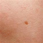 Image result for liver spots on legs