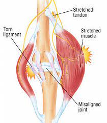 Leg Strain - Harvard Health