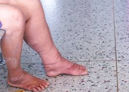 Filariasis Patient Abnormal Lymphatic Function Stock Photo - Download Image Now - Lymphedema, Edema, Leg - iStock