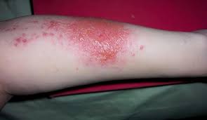 Image result for dermatitis contacta allergica