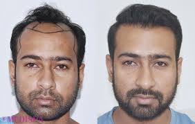 Medispa hair transplant clinic is well known among the bollywood stars for celebrity hair transplant. Hair Transplant In India Is A Worthy Decision Dr Suneet Soni S Blog Hair Restoration Network Community For And By Hair Loss Patients