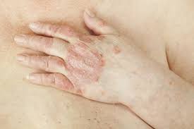 Come curare la psoriasi in modo efficace. Curare La Psoriasi In Modo Naturale E Possibile Vivere Piu Sani