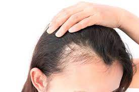 Menjaga kesehatan rambut tentu harus dilakukan jika ingin mendapatkan rambut yang sehat dan lebat. Ini 5 Cara Mudah Dan Alami Mengatasi Rambut Rontok Parah Womantalk Com Line Today