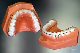 Hawley retainers, clear plastic retainers (essix, vivera, or others), or fixed or bonded retainers. Free Nhs Braces Retainers And Nhs Orthodontic Treatments Purely Orthodontics