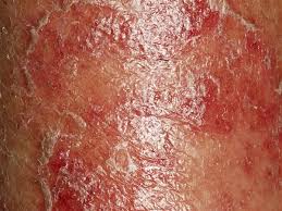 Image result for skin rash acute hiv infection