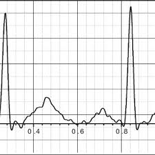 Baseline wander once the machine has printed the ekg or it is viewed on the screen prior to printing. Pdf Baseline Wandering Removal From Ecg Signal By Wandering Path Finding Algorithm