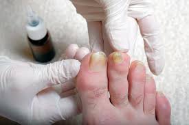 As the toenail grows out you will cut the tonails and soon your tonails will not only look healthy but will be fungus free. Yellow Toenails Prevention And Treatment Erh 1012