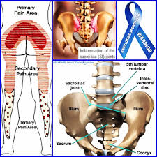 Pin On Ankylosing Spondylitis