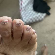 Image result for Clubbing nails feet