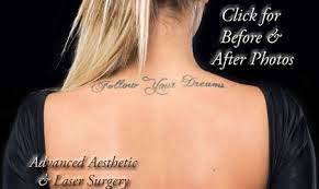Laser Tattoo Removal Faqs Columbus Oh Dublin Hilliard