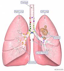 The primary risk factor for lung cancer is tobacco smoke, whether you smoked in the past or are a current smoker. Lung Cancer Newport Cardiac Thoracic Surgery
