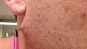 Ingrown hair is a possibility but less likely when you are threading. Yes You Could Have An Ingrown Hair This Bad On Your Bikini Line