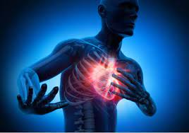 Todos ellos se caracterizan por la aparición brusca de un cuadro de sufrimiento isquémico (falta de riego) a una parte del músculo del corazón producido por la obstrucción aguda y total de una. Infarto Agudo De Miocardio En Personas Jovenes Articulos Intramed