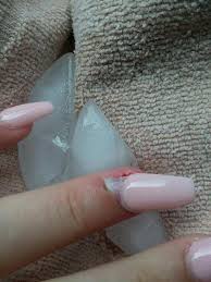 Acrylic nails are a quick way to get the long nails you've always wanted, but they're a commitment. Hit My Acrylic Nail Resulting In Lifting My Real Nail And I Believe Pushing The Nail Bed To Skin Nail Disorders Forums Patient