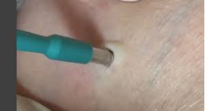 Unlike the rest of the body hairs there are a number of tips to get rid of ingrown hairs at home. Watch You Won T Believe What Was Pulled From The Cyst In This Woman S Armpit Her Ie