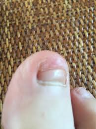 Rub it gently into the cuticle, side edges, on top and under the tip of the nail. Help Toenail Fell Off Now What With Pic Sorry Mumsnet
