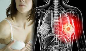Other times, it's because they asked, what can i do? and i massie adds that going through a crisis such as breast cancer is how many people learn what their friends are really made of. Breast Cancer Symptoms How Do You Know If You Have The Disease Look Out For These Signs Express Co Uk