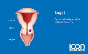 These are common symptoms of daily life, often related to food intake, muscle spasms or strains, but they also can be seen in ovarian cancer. Cervical Cancer Trung Tam Ung BÆ°á»›u Icon Singapore