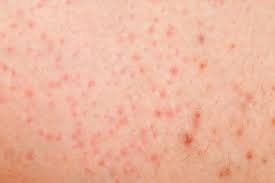 Tiny, pinpoint hemorrhages can be seen in the skin and are referred to as petechiae. What Do Red Spots On Skin Mean 13 Skin Spots Bumps Pictures