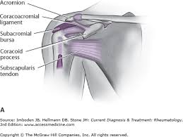 A form of arthritis in which crystals form in the joints, causing inflammation and pain. Approach To The Patient With Shoulder Pain Musculoskeletal Key