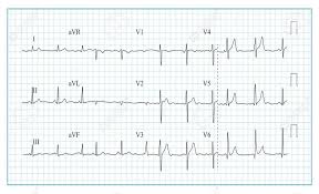 Heart Cardiogram Chart Vector Illustration Of Wave Form On Checked