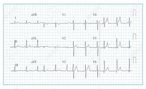 Heart Cardiogram Chart Vector Illustration Of Wave Form On Checked