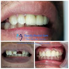 Maybe you would like to learn more about one of these? Family Dental Care Bitung Dental Bridge Gigi Tiruan Jembatan Adalah Salah Satu Jenis Gigi Tiruan Cekat Gigi Tiruan Jembatan Itu Adalah Gigi Palsu Yang Dibuat Untuk Menggantikan Satu Atau Lebih Gigi