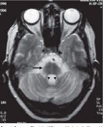 A case report and review of the literature. The Hot Cross Bun Sign Semantic Scholar