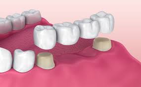 Overview Of Dental Bridges Dental Bridge Dental Implant Procedure Dental Crowns