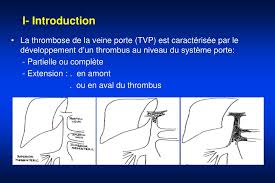 Ppt Thrombose Porte Et Cholangiopathie Portale Powerpoint Presentation Id 364172