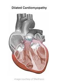 Image result for Cardiomyopathy