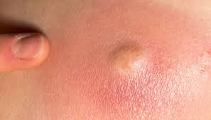 Wash it off using mild soap and cold. Cyst Vs Boil Identification Symptoms Causes And Treatments